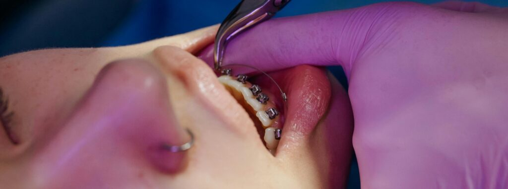 A close-up view of a dental procedure involving braces on a teen.