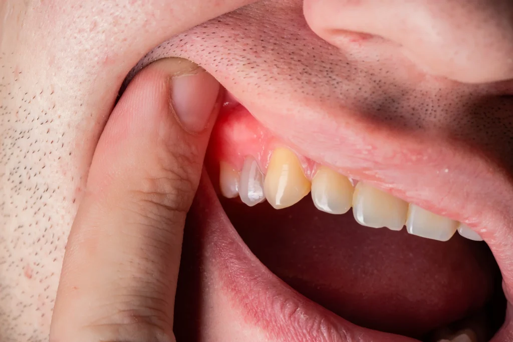 Gum Infections