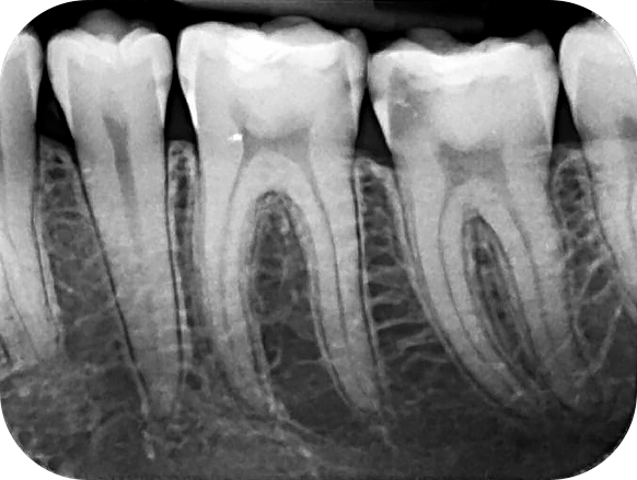 Intraoral X-ray