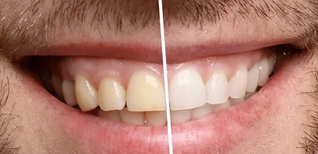 layered_emax_burbankd_dental_lab_california_06