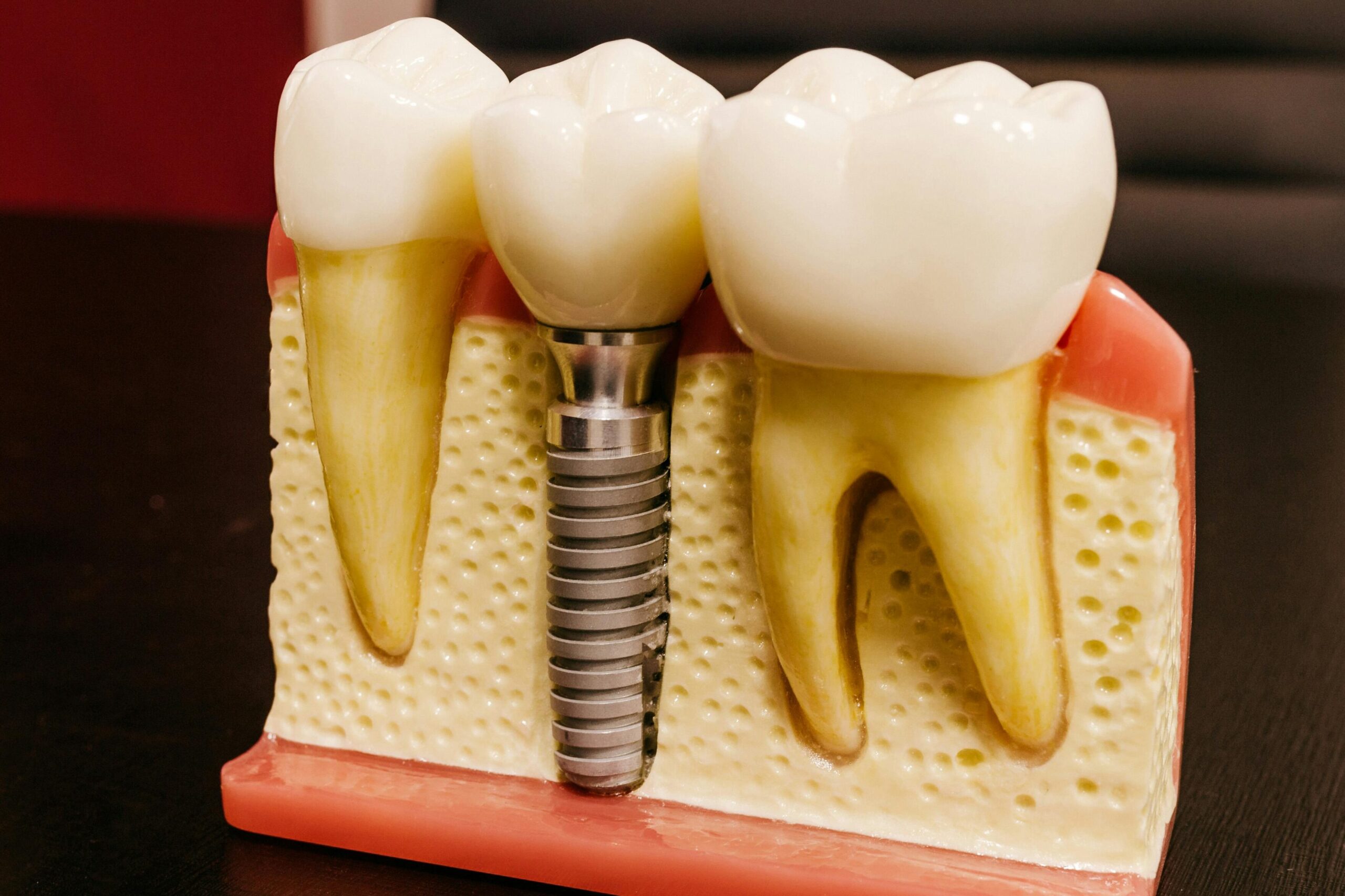 pexels-photo-4687905-4687905 Close-up of a dental implant model on a professional workspace desk.