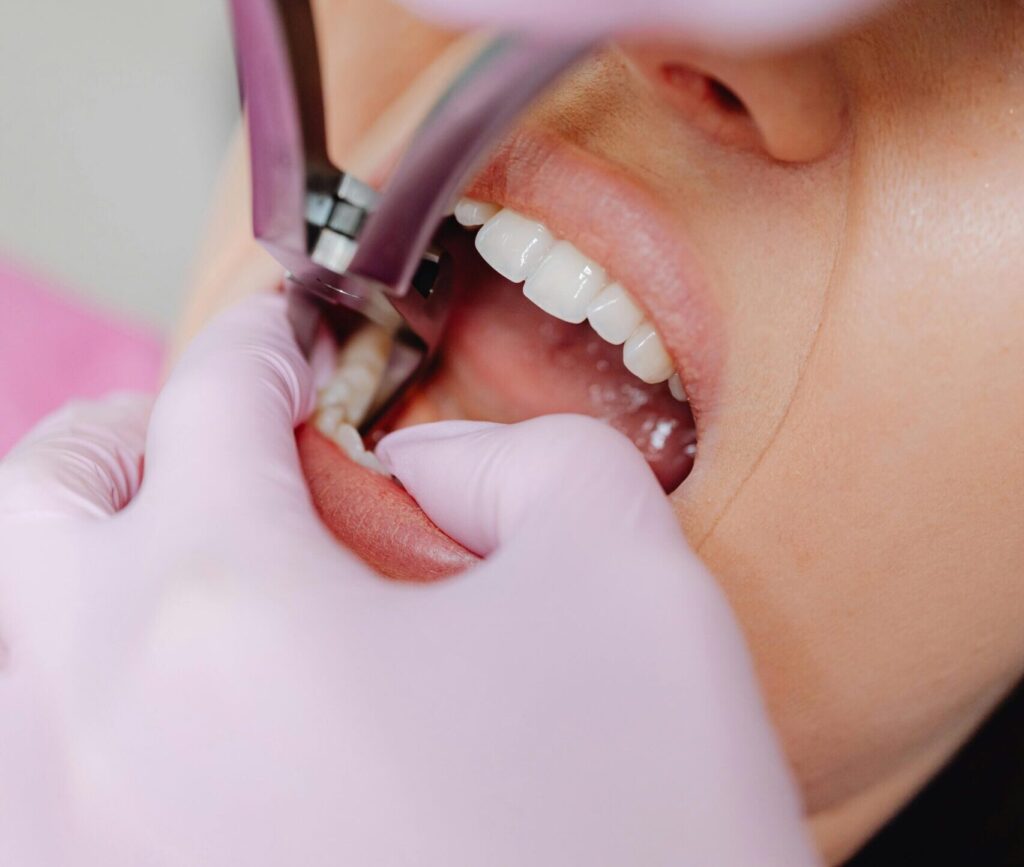 pexels-photo-6627566-6627566-1 A dentist performs a tooth extraction on a patient using extraction forceps.