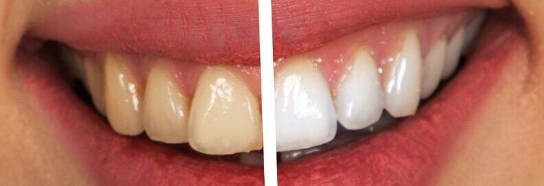 teeth-2414909_1920